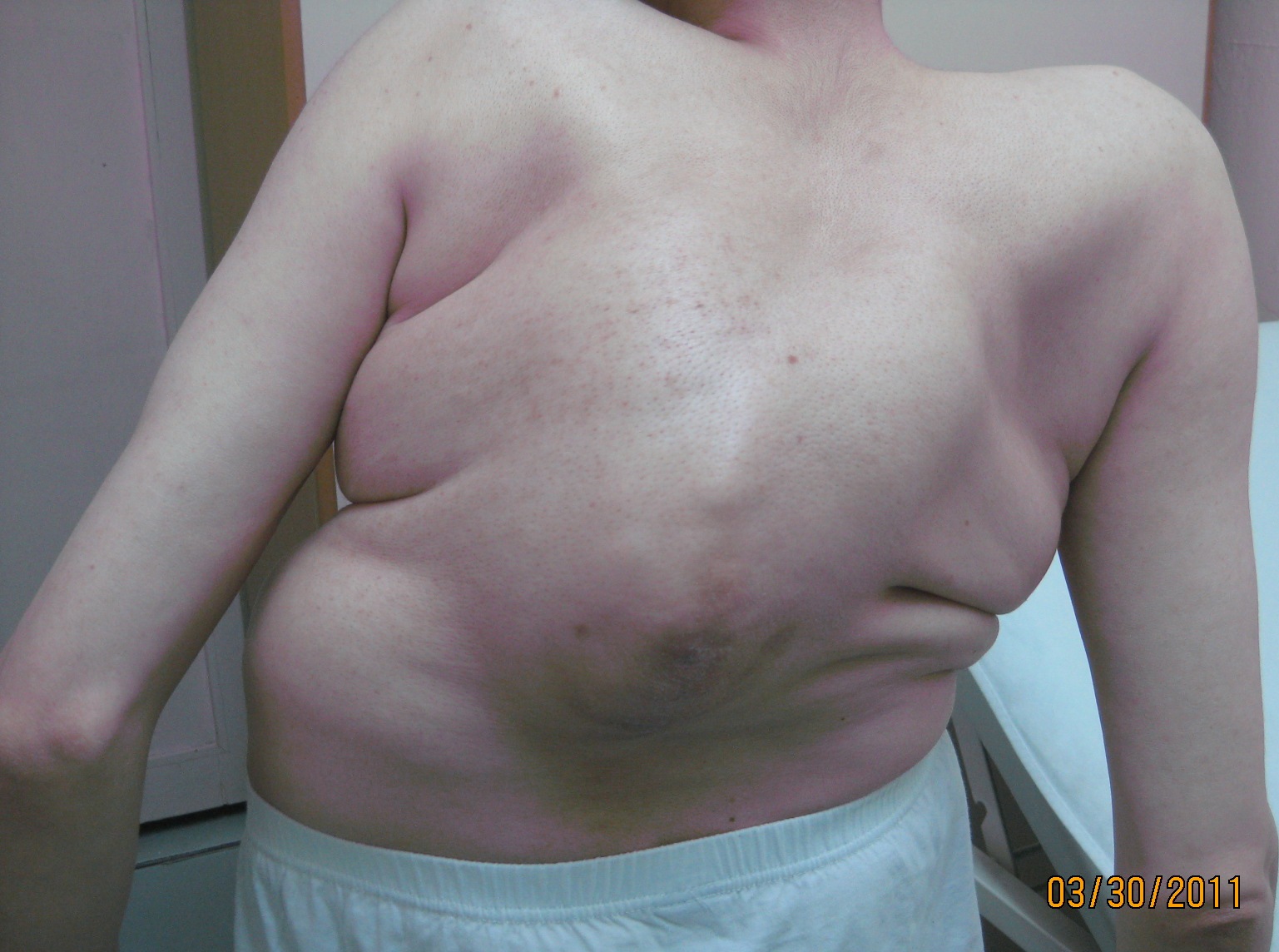 A 53 years old patient with severe kyphosis
