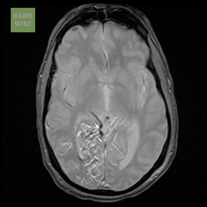 GRE image shows a large right AVM