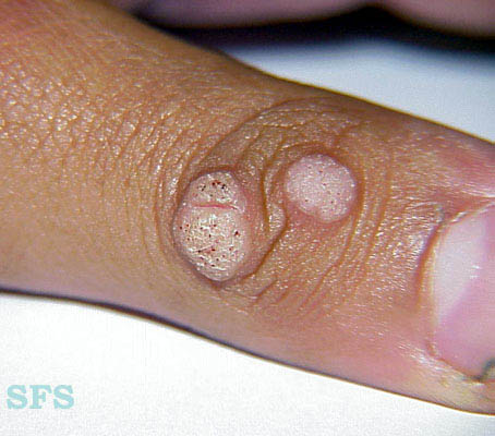 Common wart. Adapted from Dermatology Atlas.[1]