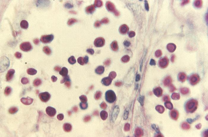 Periodic acid-Schiff-stained photomicrograph revealed some of the histopathologic details associated with a disseminated Cryptococcus sp. infection involving the liver (980x mag). From Public Health Image Library (PHIL). [10]