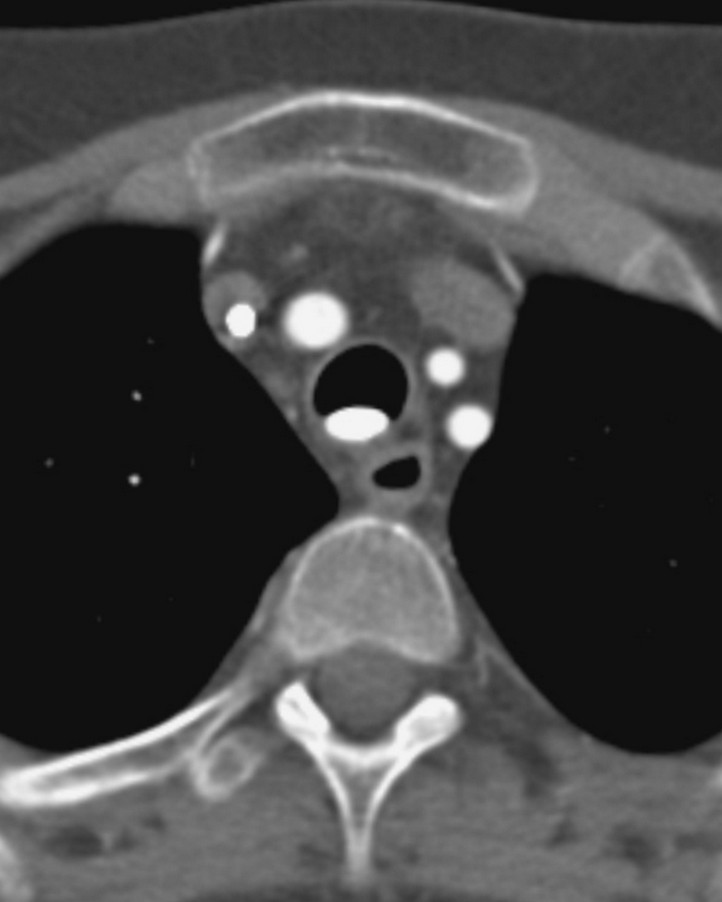 This patient collapsed on the ward and was thought to have had a pulmonary embolus. A CTPA revealed a tablet lying dependently in the patient's trachea, with changes of aspiration in both lower lobes (not shown). A second tablet was visible in the stomach... the tablet was removed via a bronchoscope and confirmed to be a Slow K (potassium). (Image courtesy of Dr Frank Gaillard)