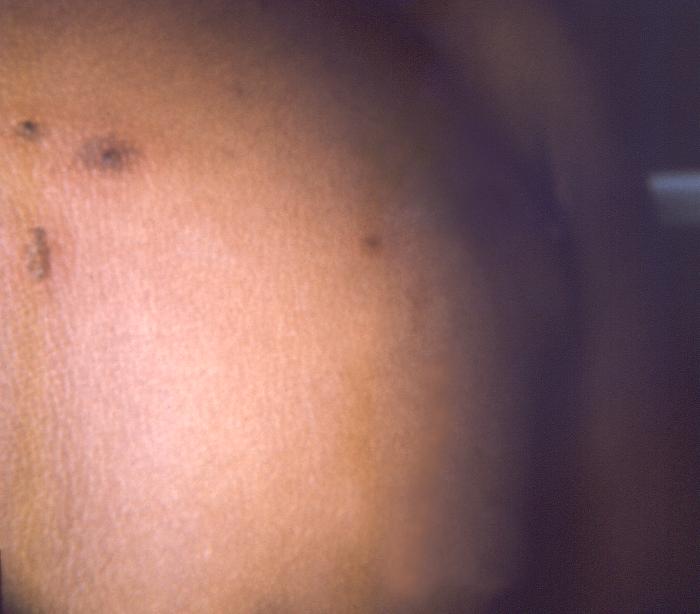 Right chest surface of a 2 year-old female patient who after receiving a smallpox vaccination in her left shoulder region, developed an erythema multiforme reaction. Note maculopapular rash, which had spread to her chest and left upper arm. Adapted from Public Health Image Library (PHIL), Centers for Disease Control and Prevention.[14]