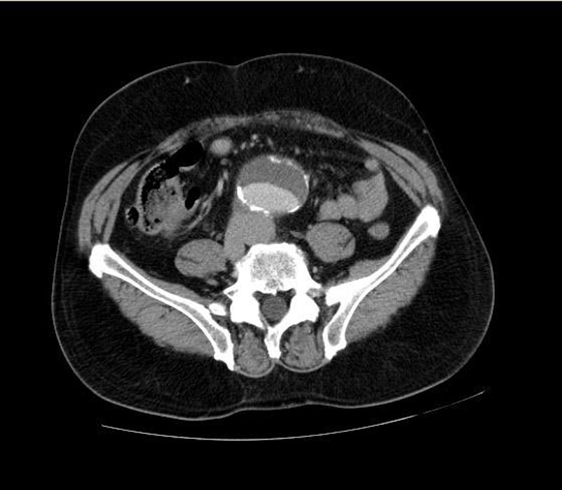 CT: a large abdominal aortic aneurysm