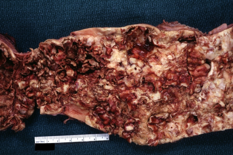 Atherosclerosis: Gross, an excellent example of ulcerated lesions with many mural thrombi