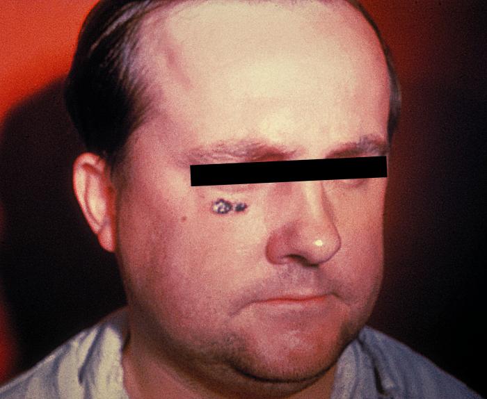 "Anthrax skin lesion on face of man. Cutaneous”Adapted from Public Health Image Library (PHIL), Centers for Disease Control and Prevention.[21]