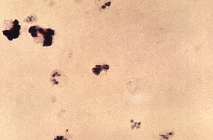 Magnified 1125X, this thick film photomicrograph revealed the presence of an immature Plasmodium vivax schizont containing a number of chromatin masses Adapted from Public Health Image Library (PHIL), Centers for Disease Control and Prevention.[6]
