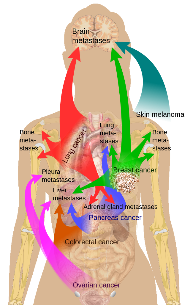 File:Metastasis sites for common cancers.png