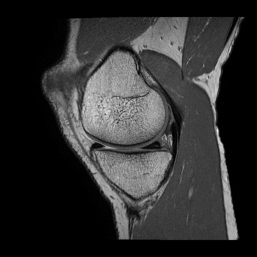 File:PD knee-mri-sagittal-pd-1.jpg