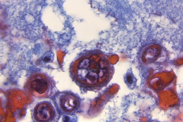 Hematoxylin-eosin (H&E)-stained photomicrograph reveals some of the cytoarchitectural histopathologic changes found in a human skin tissue specimen that included a varicella zoster virus lesion (1200x mag). From Public Health Image Library (PHIL). [6]