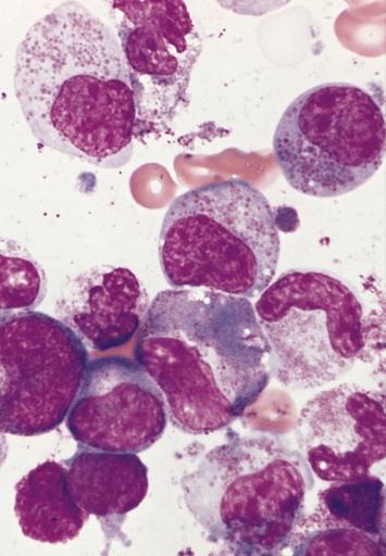 Bone marrow smear from the patient in A showing a marked increase in eosinophils at all stages of maturation. Some of the granules in immature eosinophils have a basophilic color and two of the eosinophil myelocytes have a diminished number of granules. (Wright-Giemsa stain)