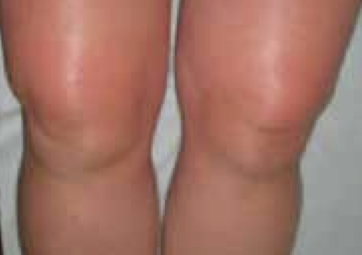 Periarticular swelling and joint effusion in knees