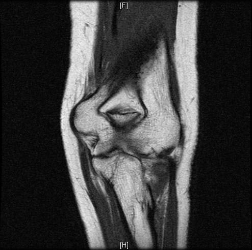 File:Normal-elbow-MRI-003.jpg