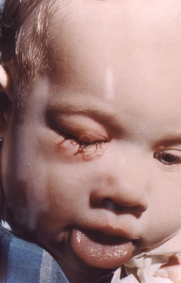 Post-smallpox vaccination complication, this 20 month-old male infant developed a secondary right periocular vaccinial infection.Adapted from Public Health Image Library (PHIL), Centers for Disease Control and Prevention.[3]