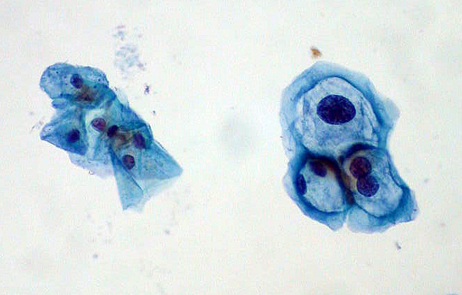 ThinPrep Pap smear with group of normal cervical cells on left and HPV-infected cells on right. The HPV-infected cells show features typical of koilocytes: enlarged (x2 or x3) nuclei and hyperchromasia.