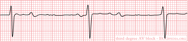 3rd degree AV block: There is no relation between P waves and QRS complexes