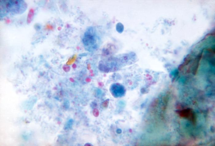 Photomicrograph reveals the presence of a trichrome-stained, Dientamoeba fragilis parasitic trophozoites in this specimen. From Public Health Image Library (PHIL). [1]