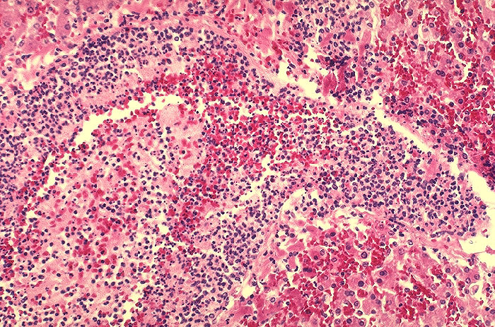 Histopathology of liver in fatal human plague. Necrosis and thrombosis of portal vein. Adapted from Public Health Image Library (PHIL), Centers for Disease Control and Prevention.[18]