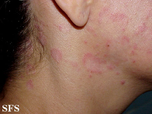 File:Seborrhoeic dermatitis 10.jpeg