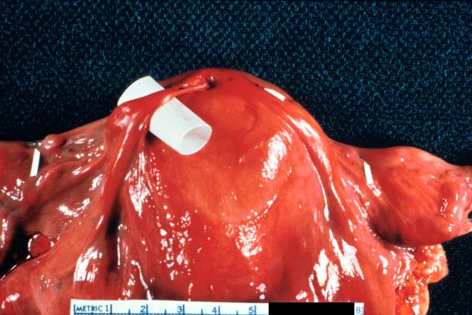This is a gross photograph of the fibrous band between the uterus and adjacent tissues. This fibrous scar tissue is probably left over from a previous surgery or an infection. A loop of bowel herniated through the opening produced by this fibrous band and became incarcerated leading to the ischemic necrosis seen in the previous image.