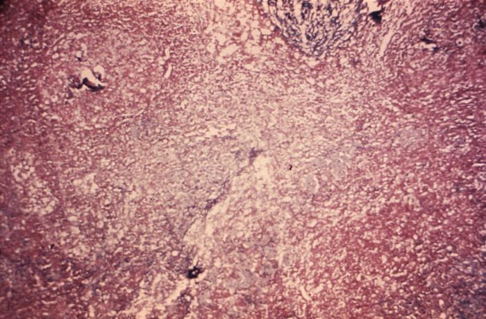 This photomicrograph reveals some of the ultrastructural histopathology in a tissue specimen from a patient with a keloidean blastomycosis infection, which was caused by the fungus, Blastomyces dermatitidis. In this particular section, you’ll note fungal invasion of a crural lymph node. From Public Health Image Library (PHIL). [2]