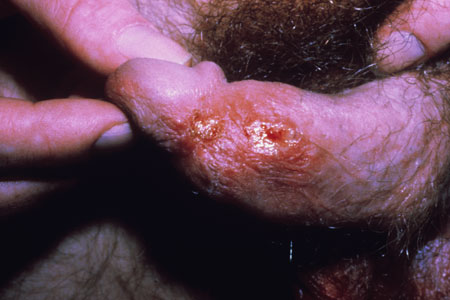 Genital Herpes Simplex Image obtained from U.S. Department of Veterans Affairs - Image Library [6] (Paul A. Volberding, MD, University of California San Francisco)
