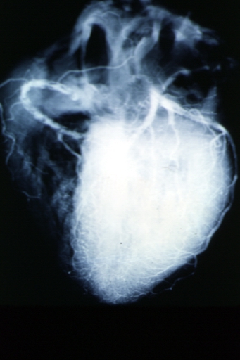 Angiogram: X-ray, postmortem coronary arteries with multiple lesions