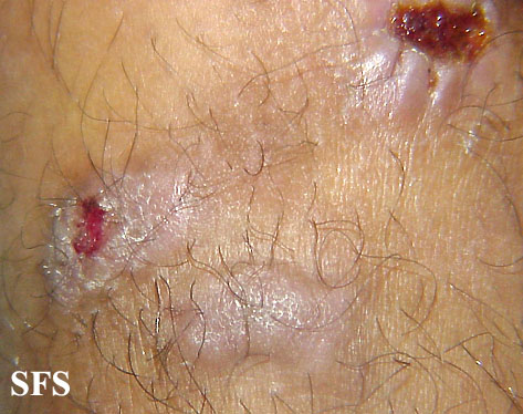 Prurigo nodularis. With permission from Dermatology Atlas.