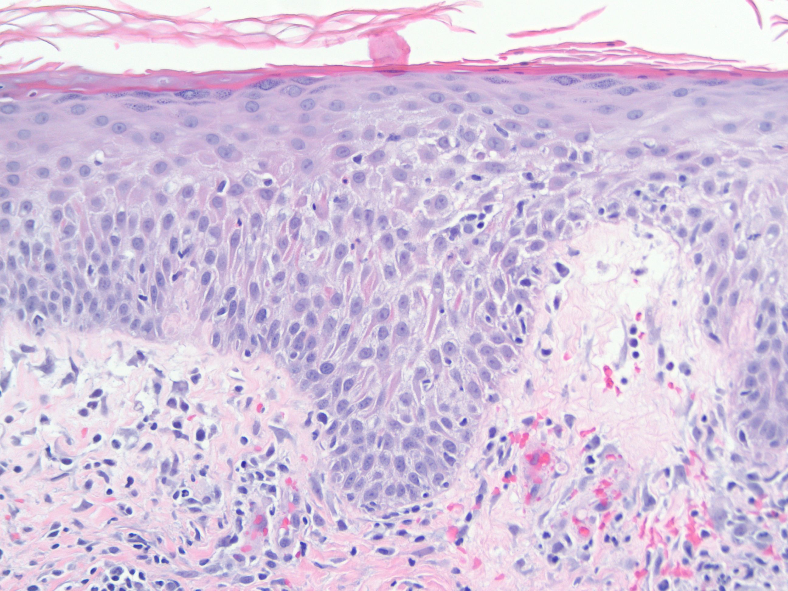Acute dematitis showing papillary edema with neutrophil infiltration.