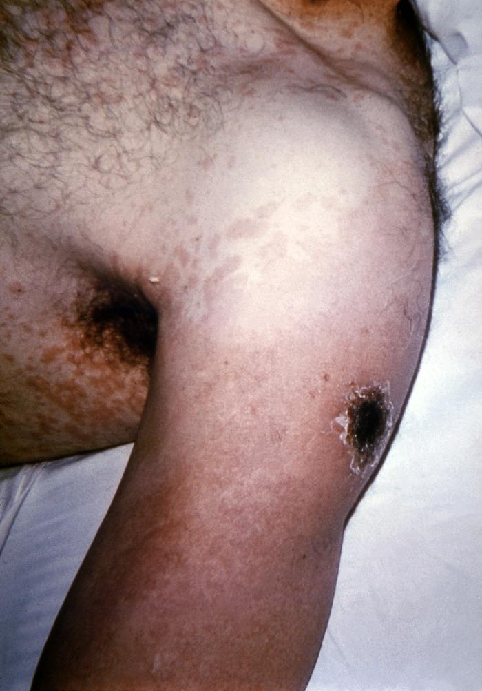 Arm of a 64 year-old male, who developed a case of generalized vaccinia, after having received a smallpox vaccination in this left shoulder.Adapted from Public Health Image Library (PHIL), Centers for Disease Control and Prevention.[3]