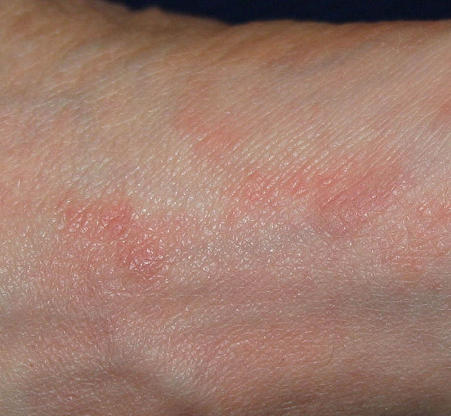 Scabies on the Foot
