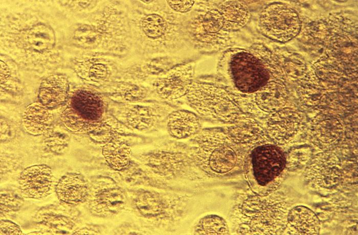 This photomicrograph reveals McCoy cell monolayers with Chlamydia trachomatis inclusion bodies; Magnified 200X. Chlamydia, caused by Chlamydia trachomatis, is the most common bacterial sexually transmitted infection. Using cell cultures from the McCoy cell line is one methods implemented in diagnosing Chlamydial infections. Adapted from CDC