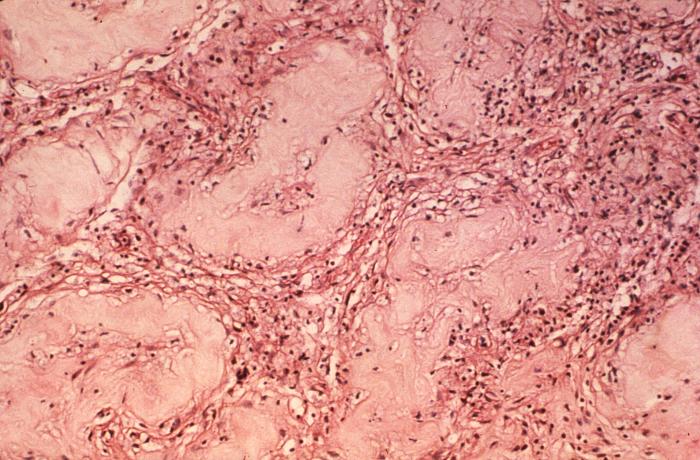 Case of lepromatous or multibacillary leprosy, with photomicrograph revealing histopathologic changes in human testicular tissue, including a large number of “foam cells”.Adapted from Public Health Image Library (PHIL), Centers for Disease Control and PreventionPublic Health Image Library (PHIL), Centers for Disease Control and Prevention[19]