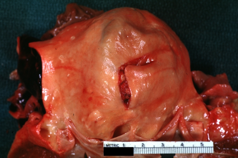 Dissecting Aneurysm: Gross good example of typical angular tear above aortic valve