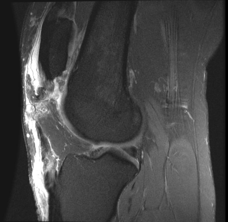 MRI: Patella alta secondary to patellar tendon rupture