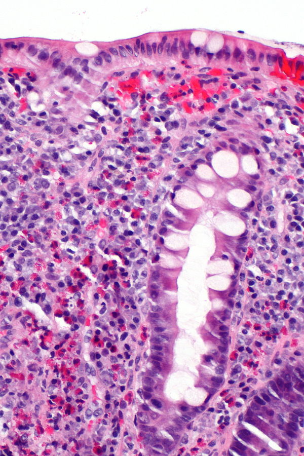 Allergic colitis. H and E stain showing abundant eosinophils - By Nephron - Own work, CC BY-SA 3.0, https://commons.wikimedia.org/w/index.php?curid=30671091