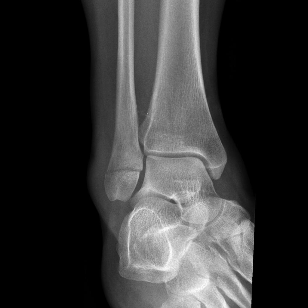 File:Ankle-fracture-weber-a-5 (3).jpg