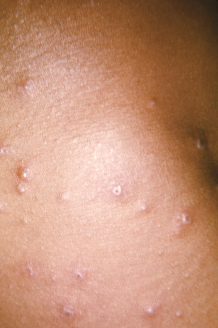 Dermal lesions determined to be due to the DNA virus, variola minor. From Public Health Image Library (PHIL). [5]