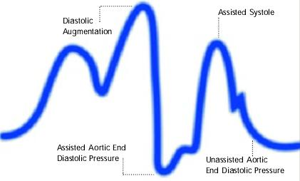 Premature deflation of the intra aortic balloon during the diastolic phase characterized as; deflation of balloon is seen as a sharp drop following diastolic augmentation, sub-optimal diastolic augmentation, assisted aortic end diastolic pressure may be equal to or less than the unassisted aortic end diastolic pressure and assisted systolic blood pressure may rise.