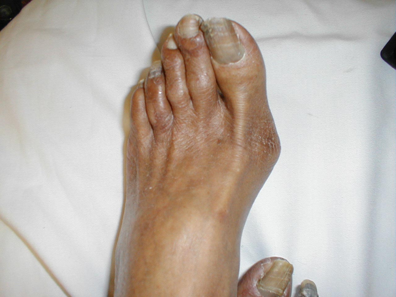Same patient. Normal left foot for comparison.