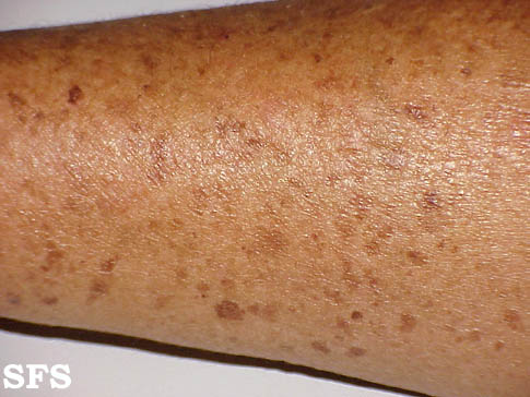 Liver spot. Adapted from Dermatology Atlas.[1]
