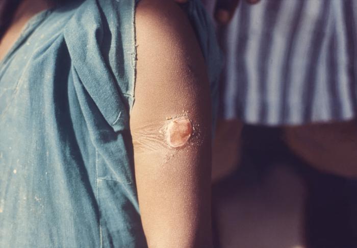 Girl who received a smallpox vaccination in the left upper arm displayed a local complication at the vaccination site, where a chronic superinfection resulted in a granulation tissue reaction. Adapted from Public Health Image Library (PHIL), Centers for Disease Control and Prevention.[14]