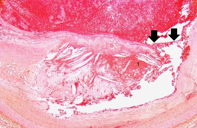 This is a higher-power photomicrograph of the ruptured fibrous cap (arrows) with hemorrhage (1) into the atherosclerotic plaque.