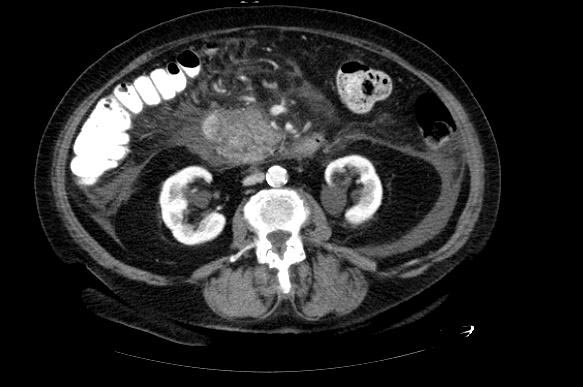 File:Gallstone-pancreatitis-005.jpg