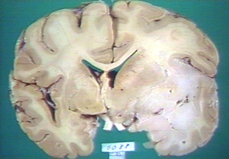 Brain: Oligodendroglioma, Mixed Astrocytoma & Oligodendroglioma