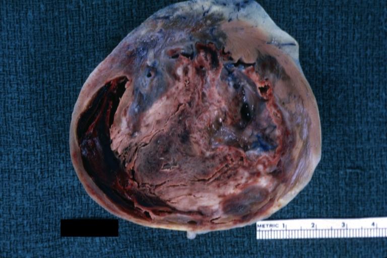 Left Ventricle Aneurysm: Gross natural color horizontal section apex of left ventricle with aneurysmal dilation and mural thrombus. A large scar tissue in myocardium.