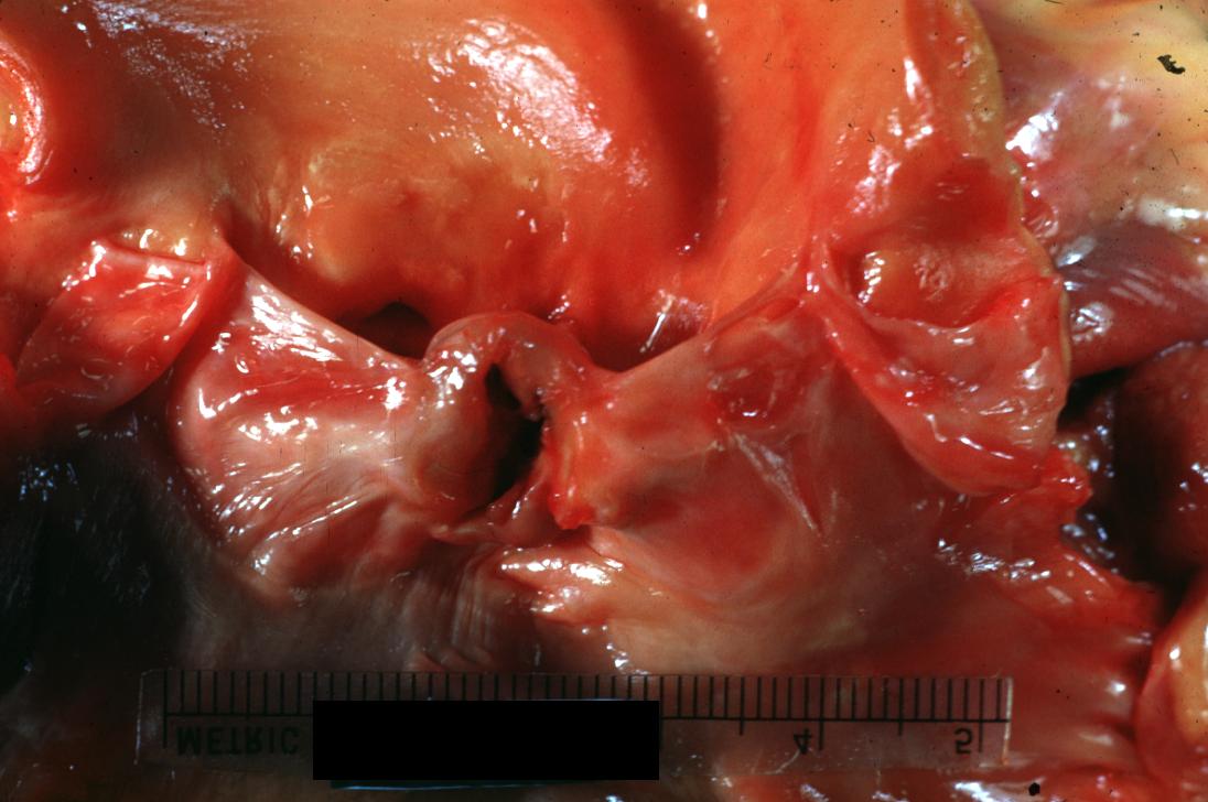 Bacterial Endocarditis: (Gross) Perforated aortic valve cusp is shown.
