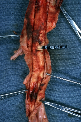 Dissecting Aneurysm: Gross opened false channel.