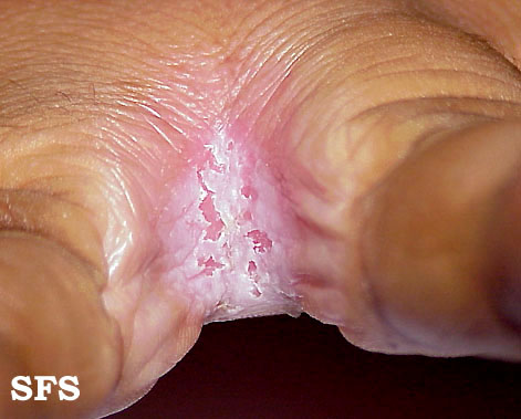Candidiasis. Adapted from Dermatology Atlas.[2]
