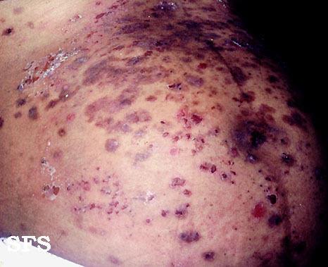 File:Herpes gestationis 09.jpeg