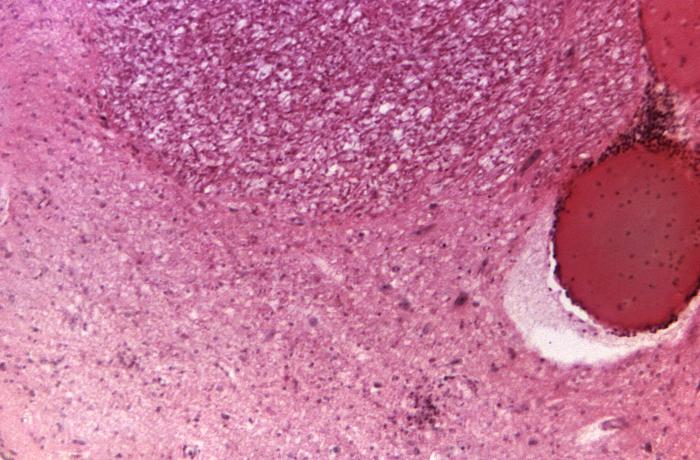 Under a low magnification, this photomicrograph of pontine tissue at the level of abducens nucleus reveals histopathologic changes in a poliomyelitis patient.Adapted from Public Health Image Library (PHIL), Centers for Disease Control and Prevention.[15]